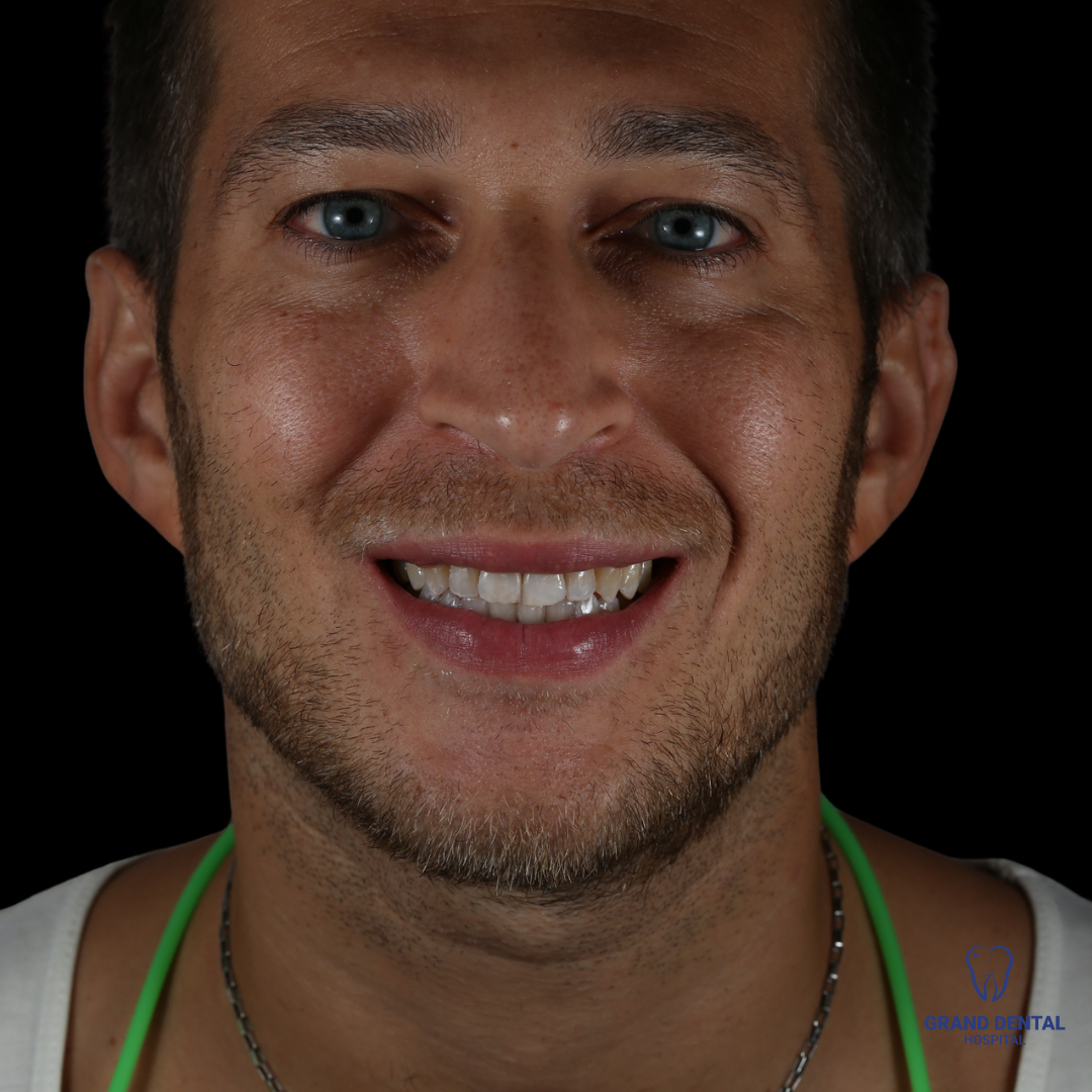 image before