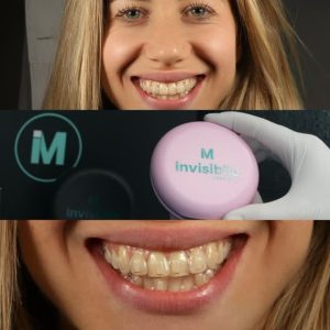 Maskarina transparente për drejtimin e dhëmbëve Grand Dental Hospitality