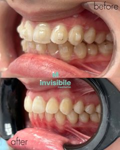 Pacient gjatë trajtimit me maskarina transparente Grand Dental