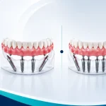 Arcata completa su impianti fasi, tempi e soluzioni grand dental hospital