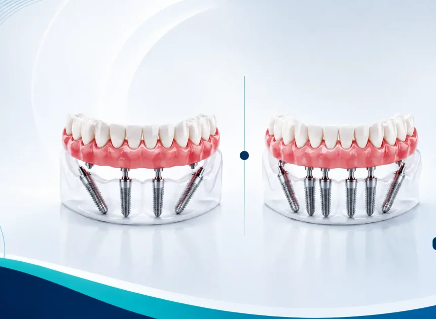 Arcata completa su impianti fasi, tempi e soluzioni grand dental hospital
