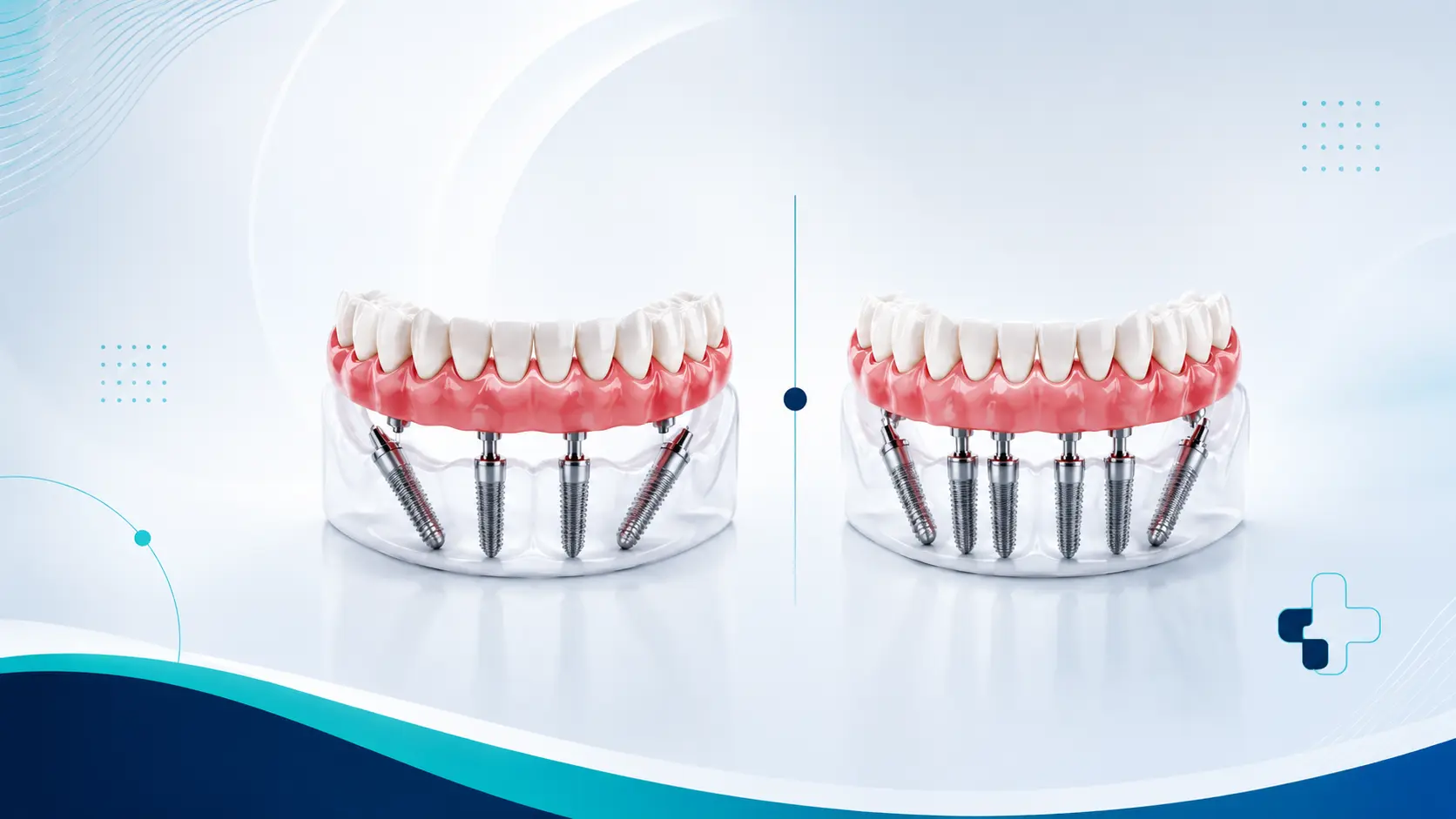 Arcata completa su impianti fasi, tempi e soluzioni grand dental hospital