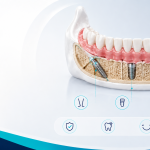 Denti fissi su impianti in Albania grand dental hospital