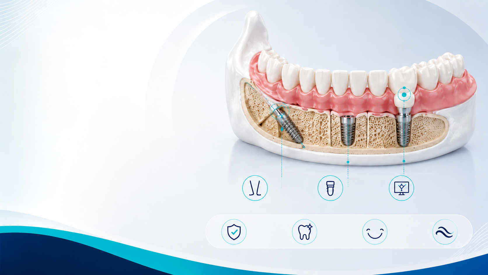 Denti fissi su impianti in Albania grand dental hospital