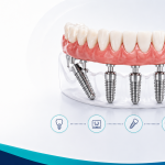 Meglio All-on-4 o All-on-6? La risposta dipende dal paziente grand dental hospital.png