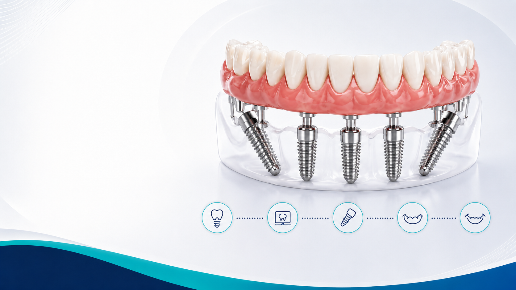 Meglio All-on-4 o All-on-6? La risposta dipende dal paziente grand dental hospital.png