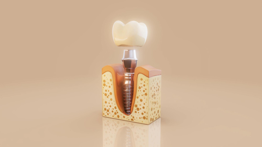 Grand-Dnetal-Hospital-Dnetal-Implants-In-Albania